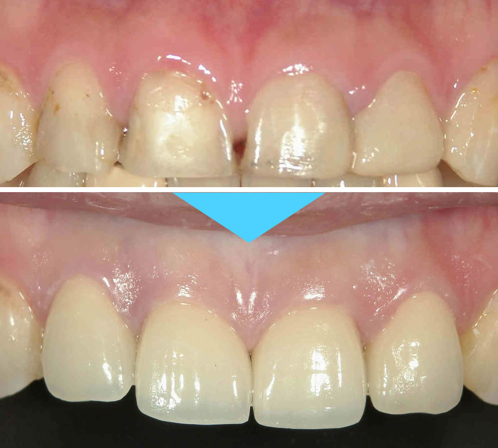 前歯のオールセラミック治療症例