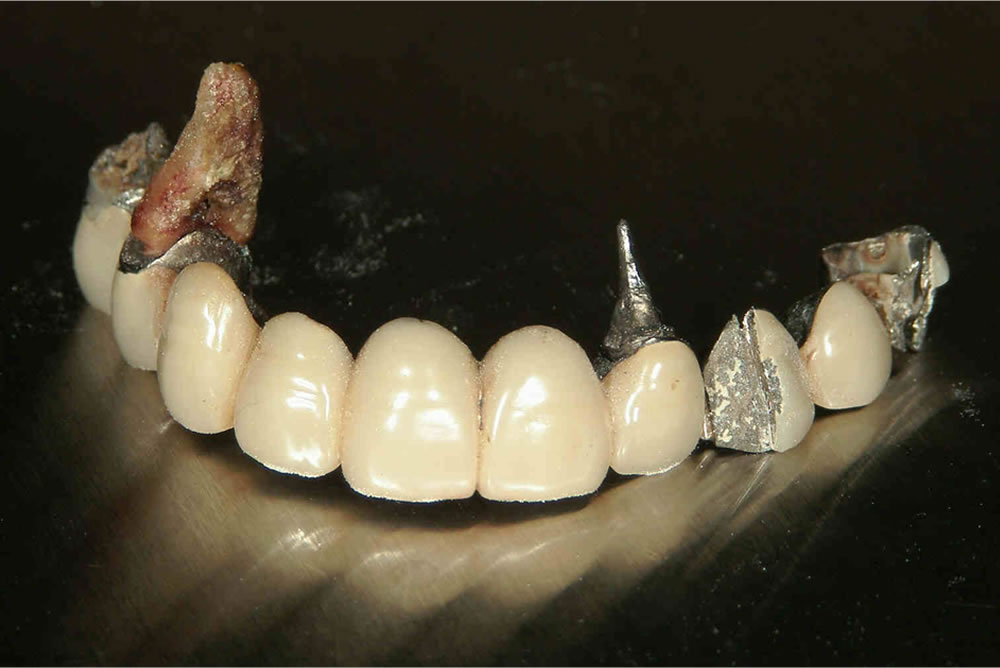 保存困難な歯を抜歯