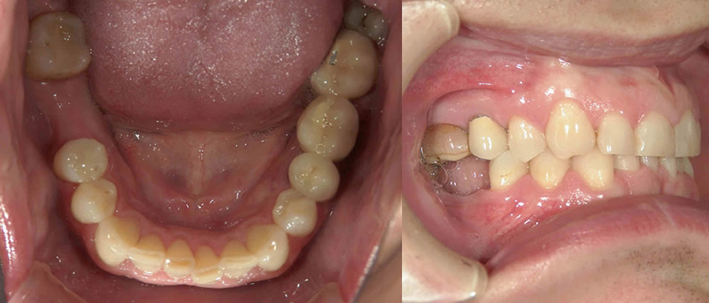 インプラント治療前