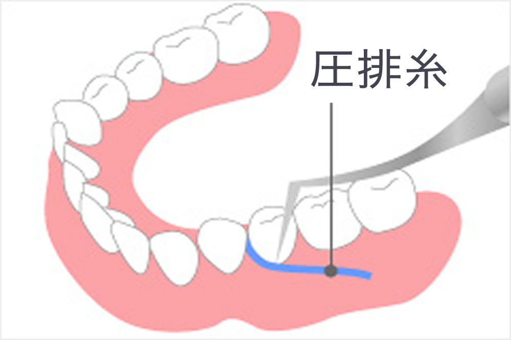 拡大視野下での形成