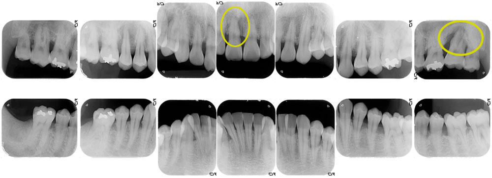 歯周病のレントゲン