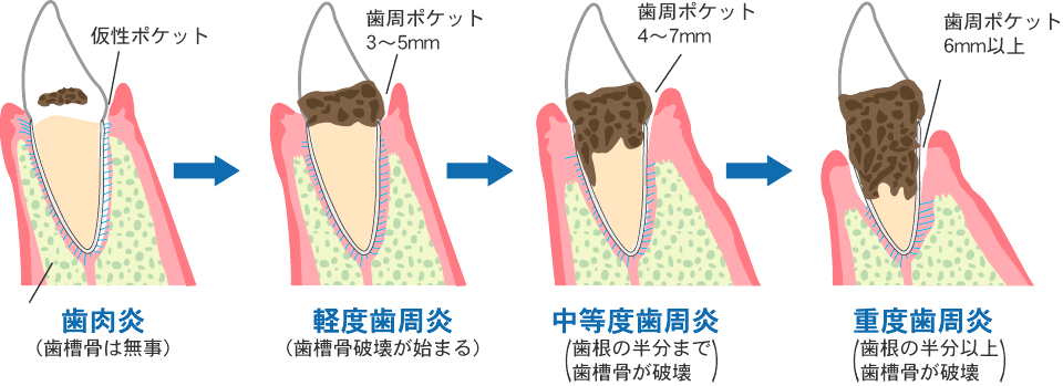 一般的な歯周病治療