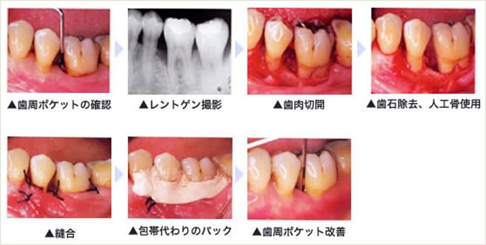 歯周外科・歯周再生療法